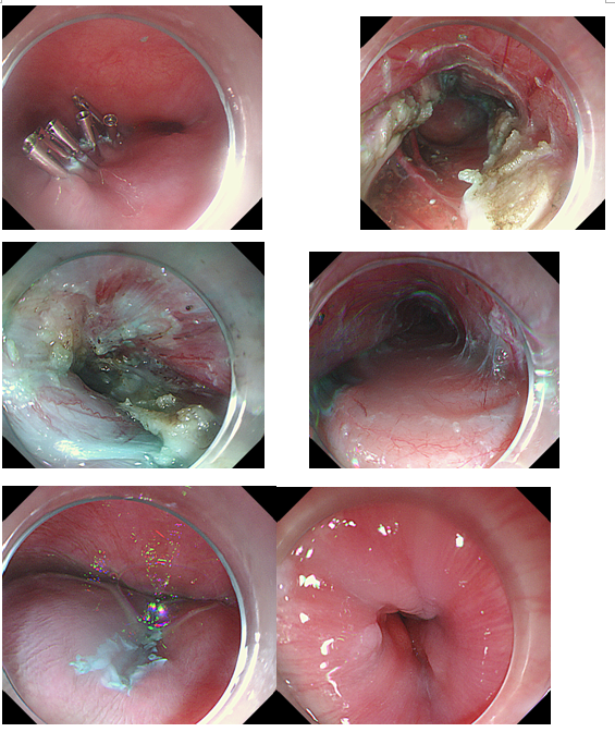 为29岁小伙打开贲门的“枷锁” ——我院消化内科成功开展首例经口内镜下肌切开术