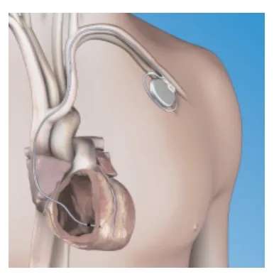 “小神器”解决“大难题”——我院完成嵊州市首例无导线起搏器植入手术