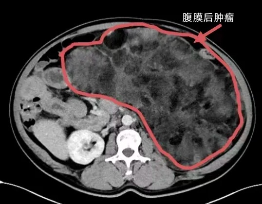 头条丨以为是发胖，结果医生从肚子里切除一个“大西瓜”！50岁大叔懵了......