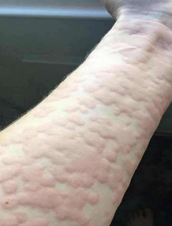 痒了半年睡不了一个整觉，50多岁的她差点崩溃！医生：这种“风疙瘩”真不能硬扛