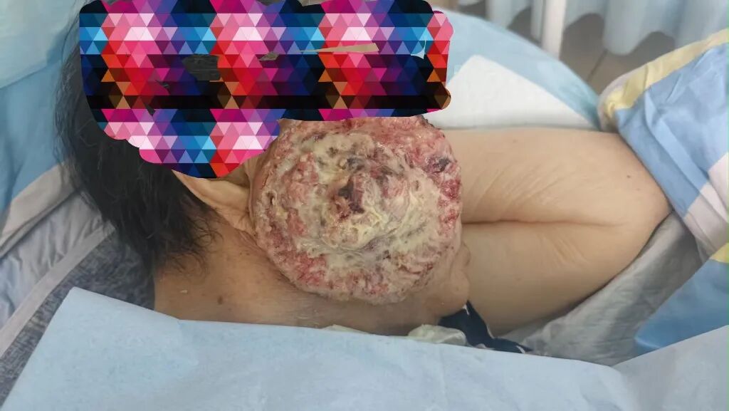 九旬老人罹患面部鳞癌 精准放疗攻克高龄诊疗难题